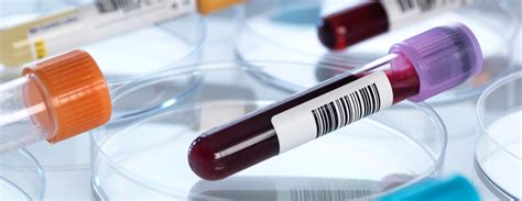 idc test rates blood cp|Ceruloplasmin Test: MedlinePlus Medical Test.